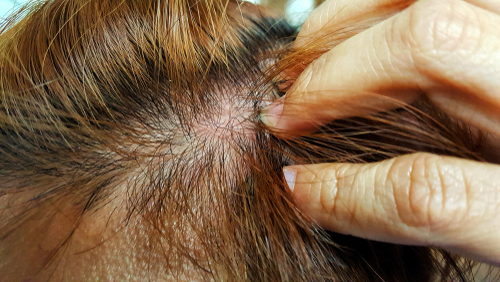 What are the Signs Of A Hair Loss Situation?
