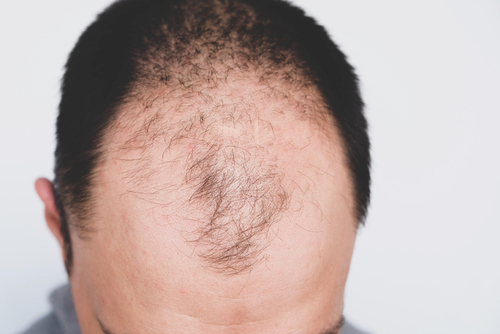 What are the Signs Of A Hair Loss Situation?